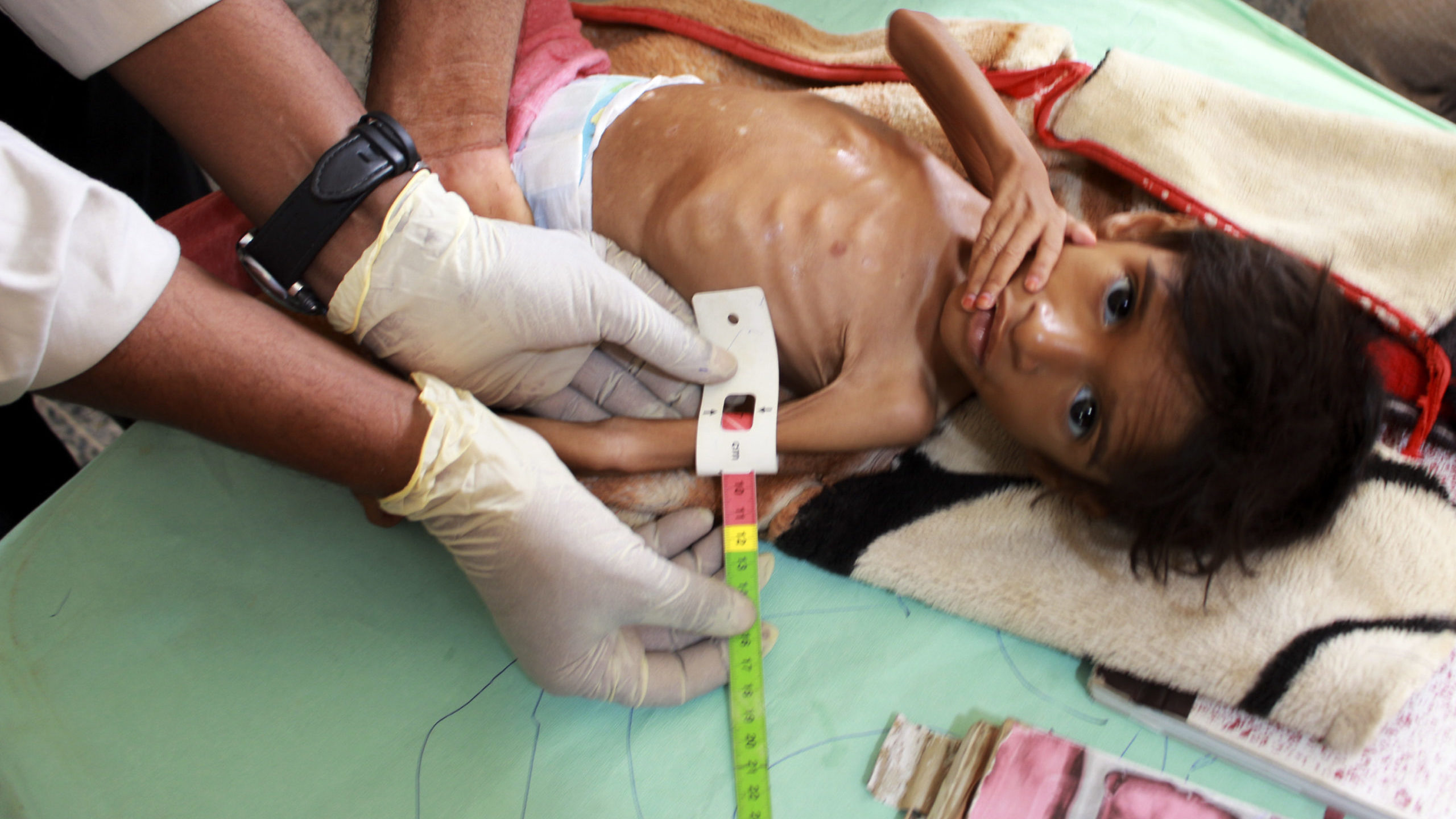 Donors Countries Raise Less Than 1/3 Funds Needed To Combat Hunger in Yemen