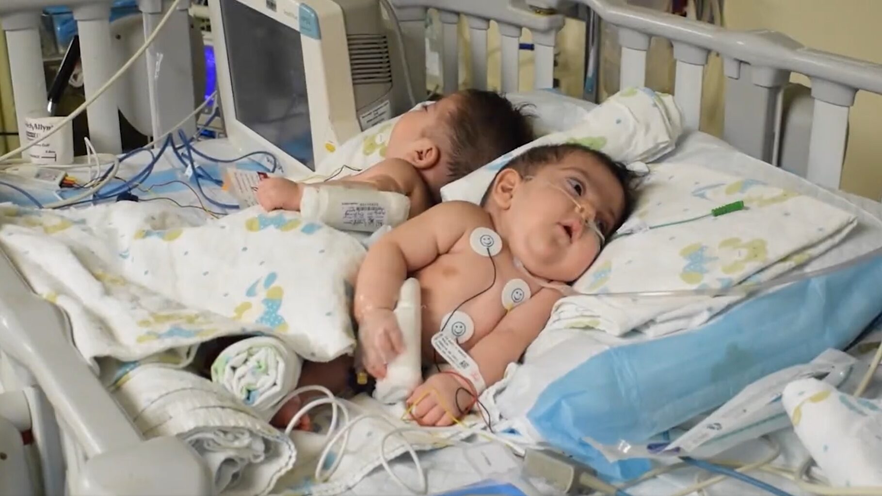 Doctors Perform First Separation of Conjoined Twins in Lebanon