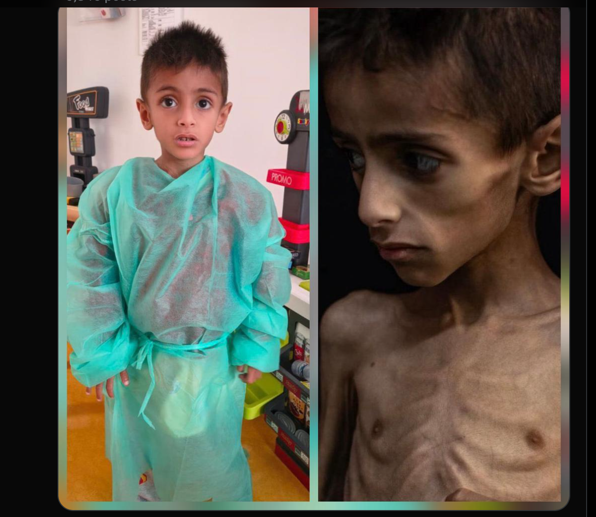 Israel Refutes Starvation Claims After Gaza Child’s Illness Found Unrelated to War